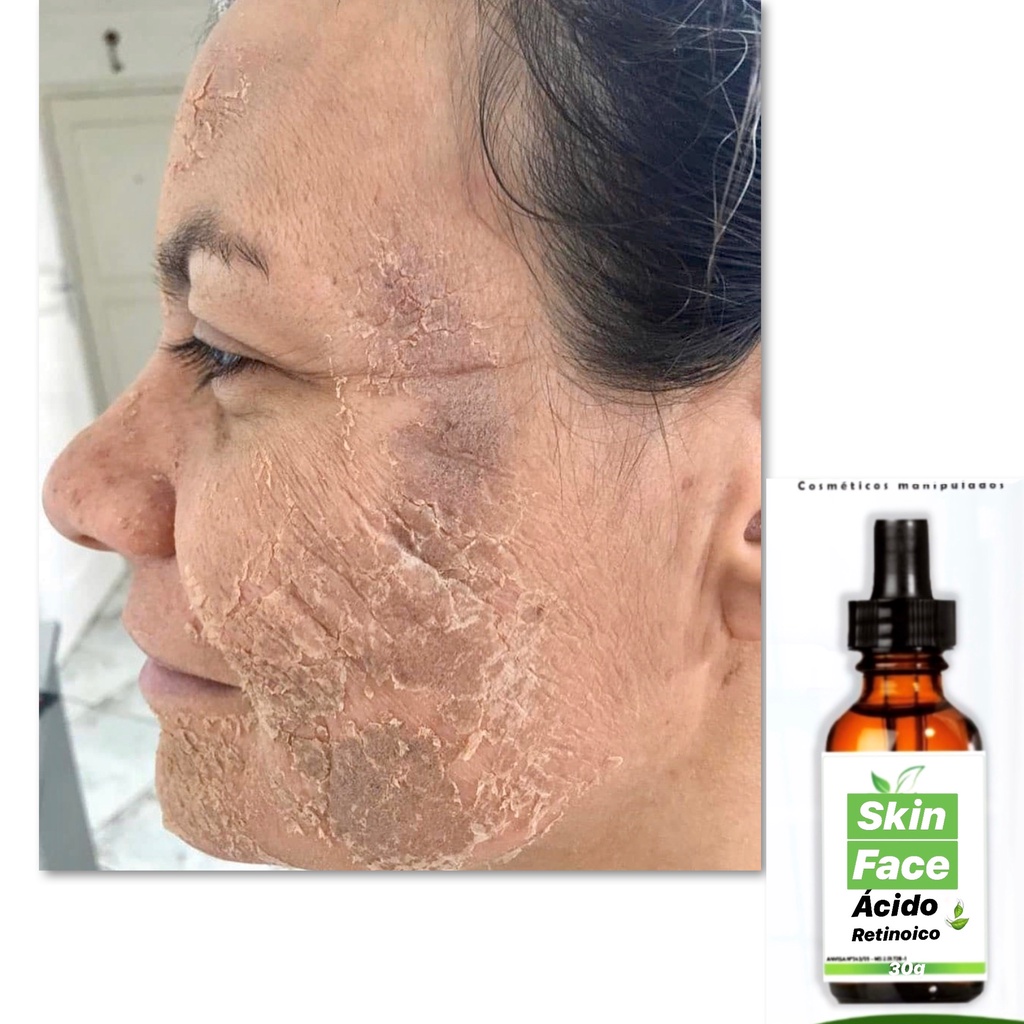 Clareador Facial Acne Manchas Melasma Peeling 10ml Postamos De