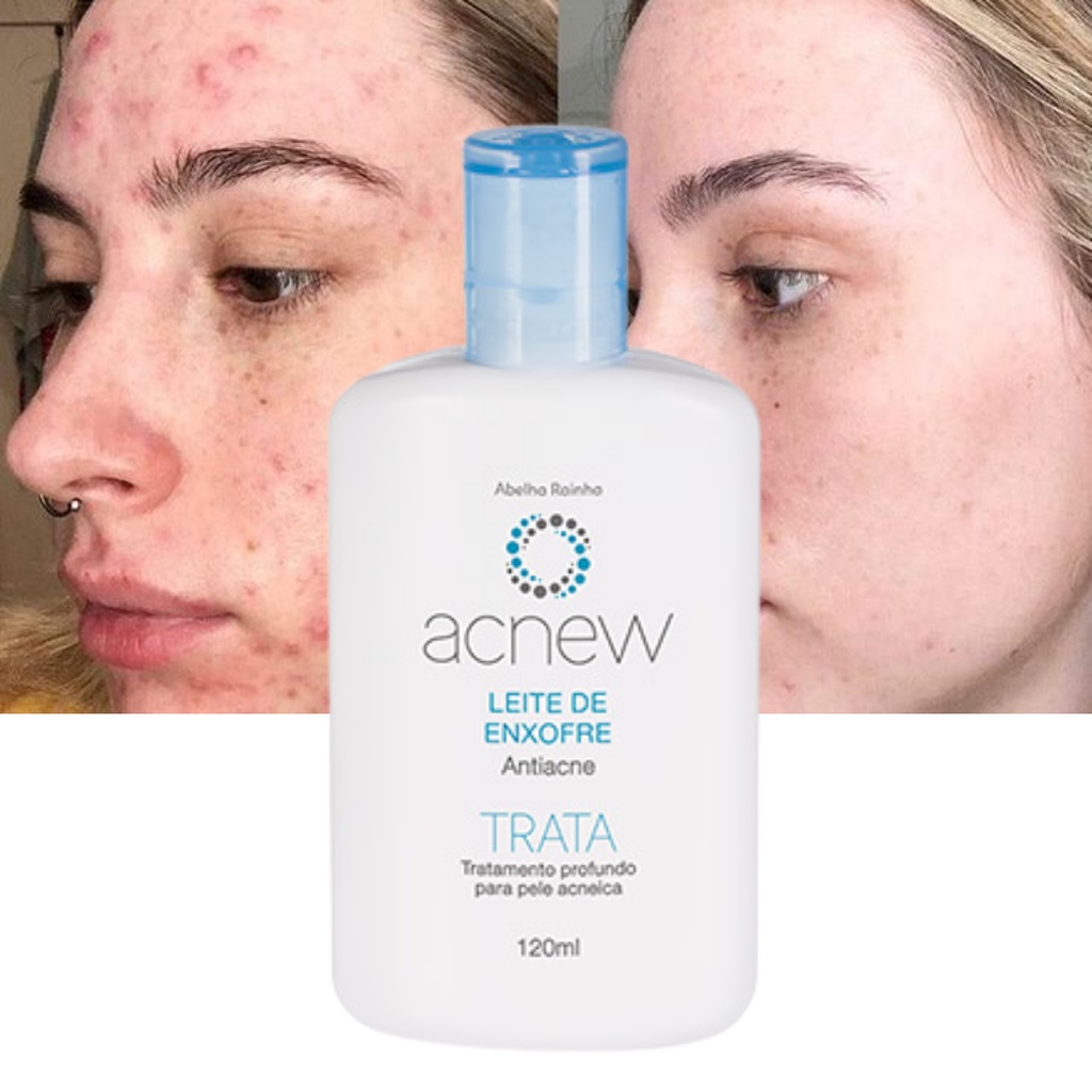 Leite De Enxofre Antiacne TRATA Acnew Abelha Rainha 120ml Shopee Brasil