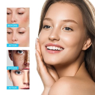 Creme De Clareador Ibealee Remove Melasma Acne Pigmento Mancha De