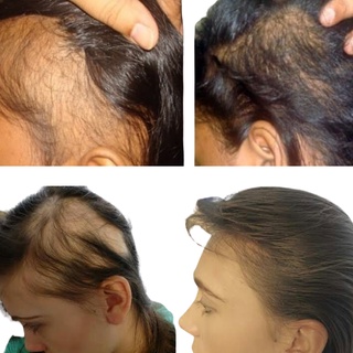 Tratamento Alopecia Areata Calvície E Anti Queda Original Shopee Brasil