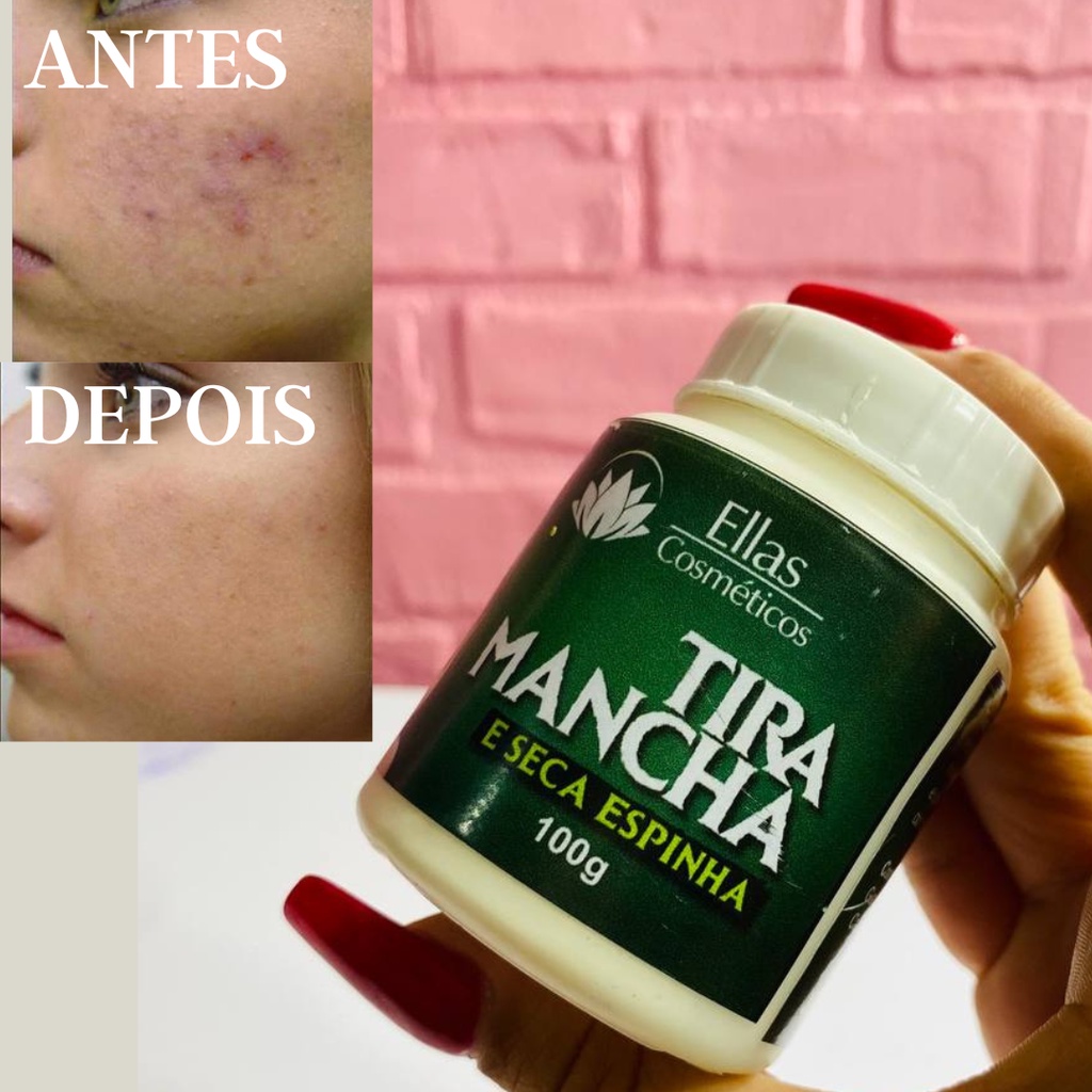 Tira Mancha E Seca Espinha Tratamento De Acne Ellas Cosmeticos G