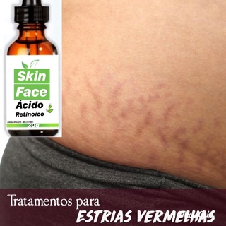 clareador de estrias acido retinoico 40 % 30ml enviamos de imediato