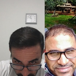 tratamento pra calvície, para homens e mulheres