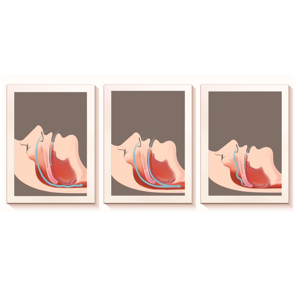 Kit 3 Quadros Decorativos Apneia do Sono Decoração Consultório Médico Otorrinolaringologia  Molduras 20x30cm Madeira