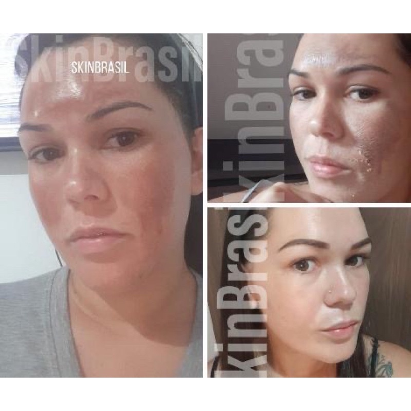 anti acne removedor melasma e manchas (20ml retinol + 10ml peeling 3D + 2 tca)
