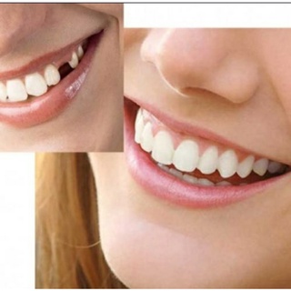 Dentes Postiço De Resina + massa Fixar. Avulso. A2. Provisórios. 10 dentes. Dentes Postiços, Removível, Ocos, de Encaixe, Reposição Dentária