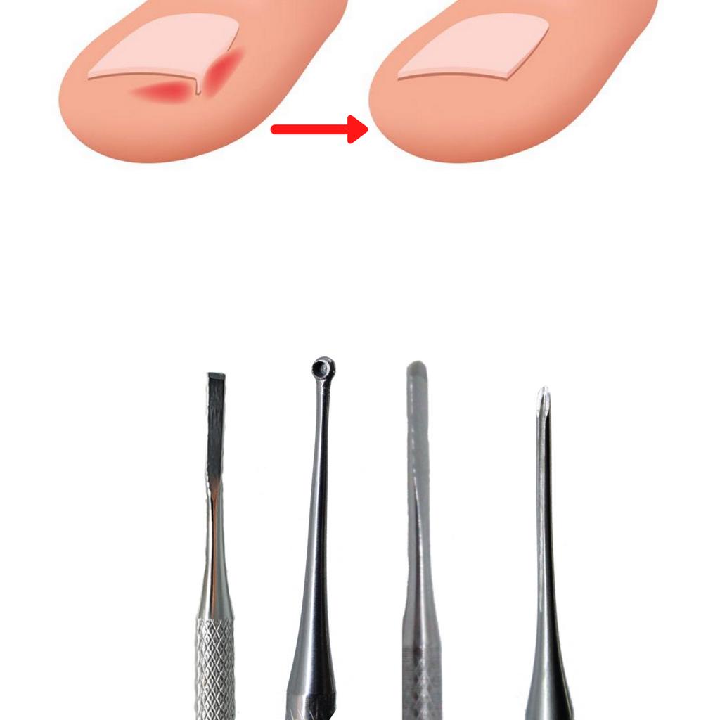 Kit de Instrumentos Para Podologia Tratamento Unha Encravada