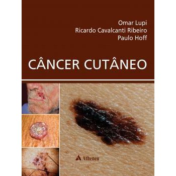 CANCER CUTANEO - Omar Lupi