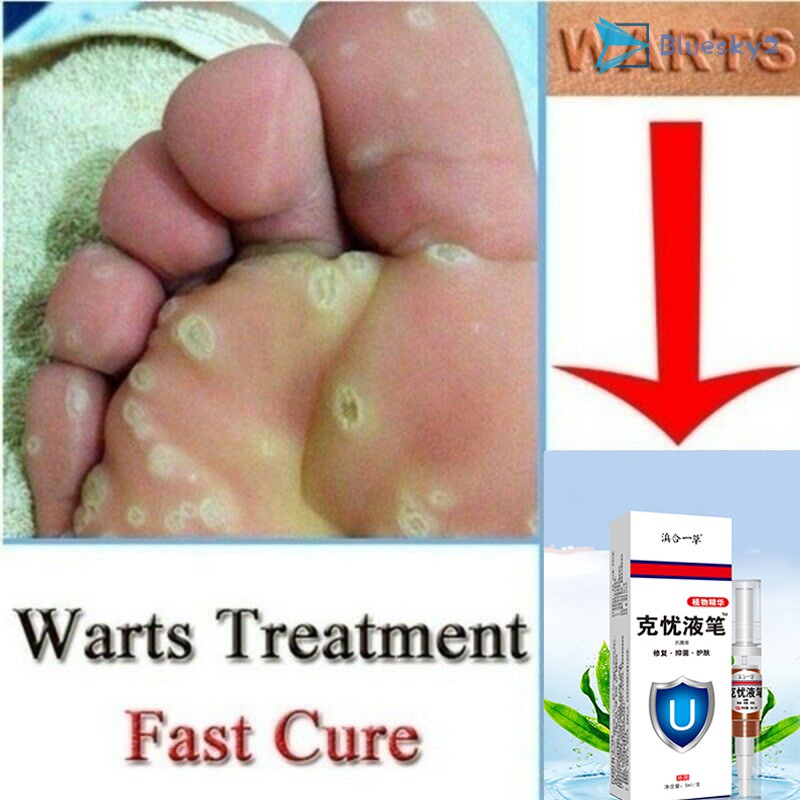 foot warts disease treatment