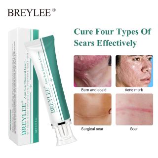 Breylee Creme De Remoção De Cicatrizes Acne 30g Para O Rosto Reparação Pele Cuidados Com Os Tratamento Remover Manchas Estérios Clareador 1 Pcs