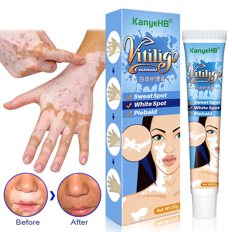 20g-pomada-de-extrato-de-ervas-vitiligo-para-remover-de-anel-pele-e