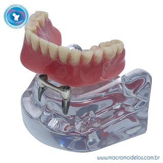 Macro Modelo Manequim Odontológico Overdenture em Acrílico com Implantes Barra Clip Prótese