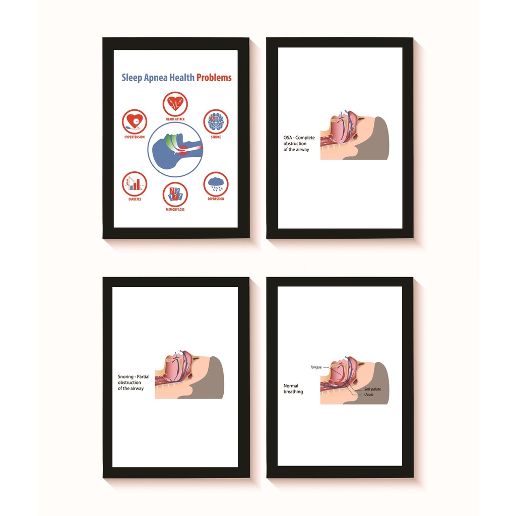 Kit 4 Quadros Apneia do Sono Decoração Decoração Consultório Médico Otorrinolaringologia Moldura 20x30cm Madeira