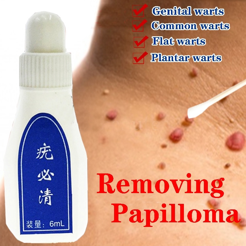 papilloma removal cream