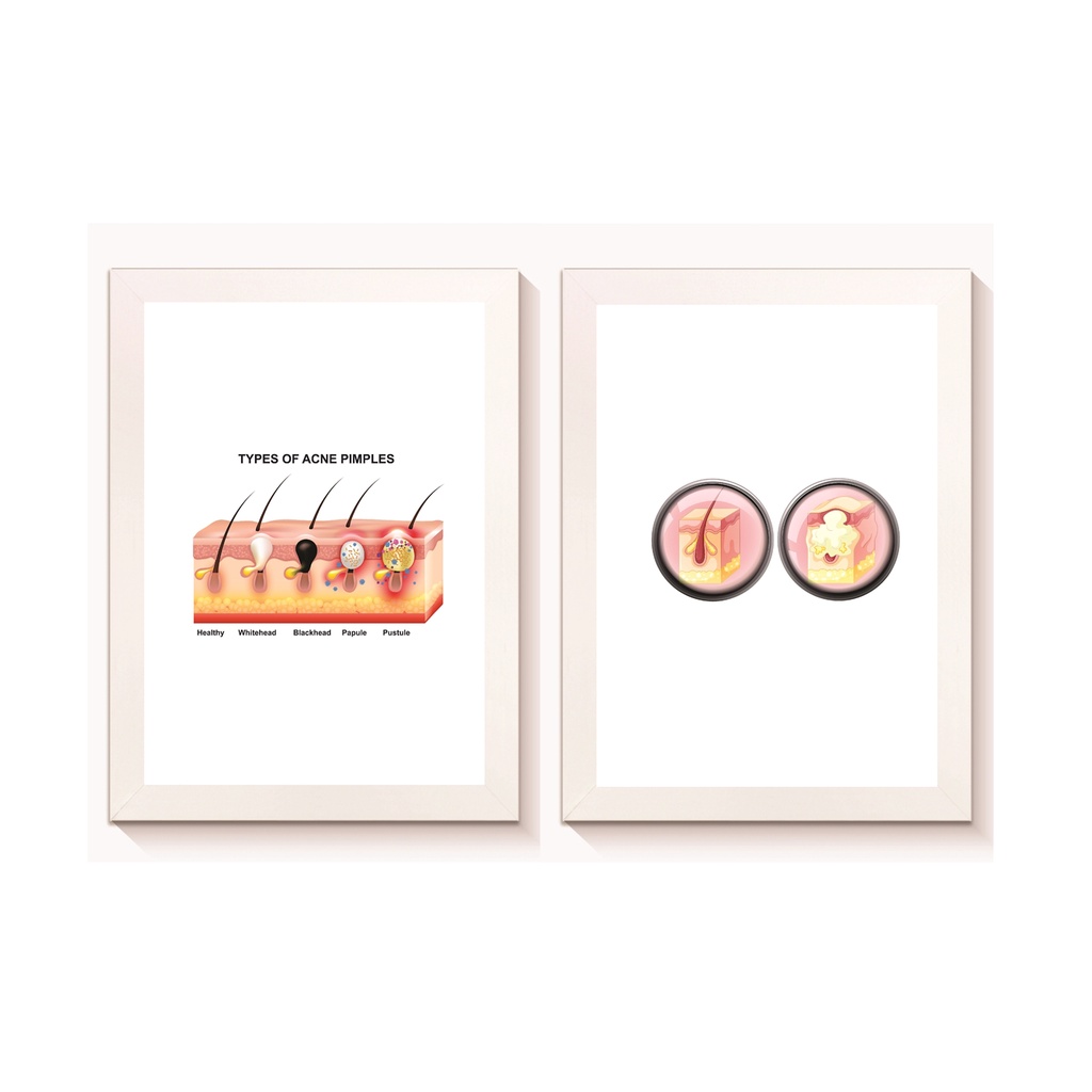 Kit 2 Quadros Decorativos Acne Dermatologia Medicina Consultório Molduras 20x30cm Madeira Vidro