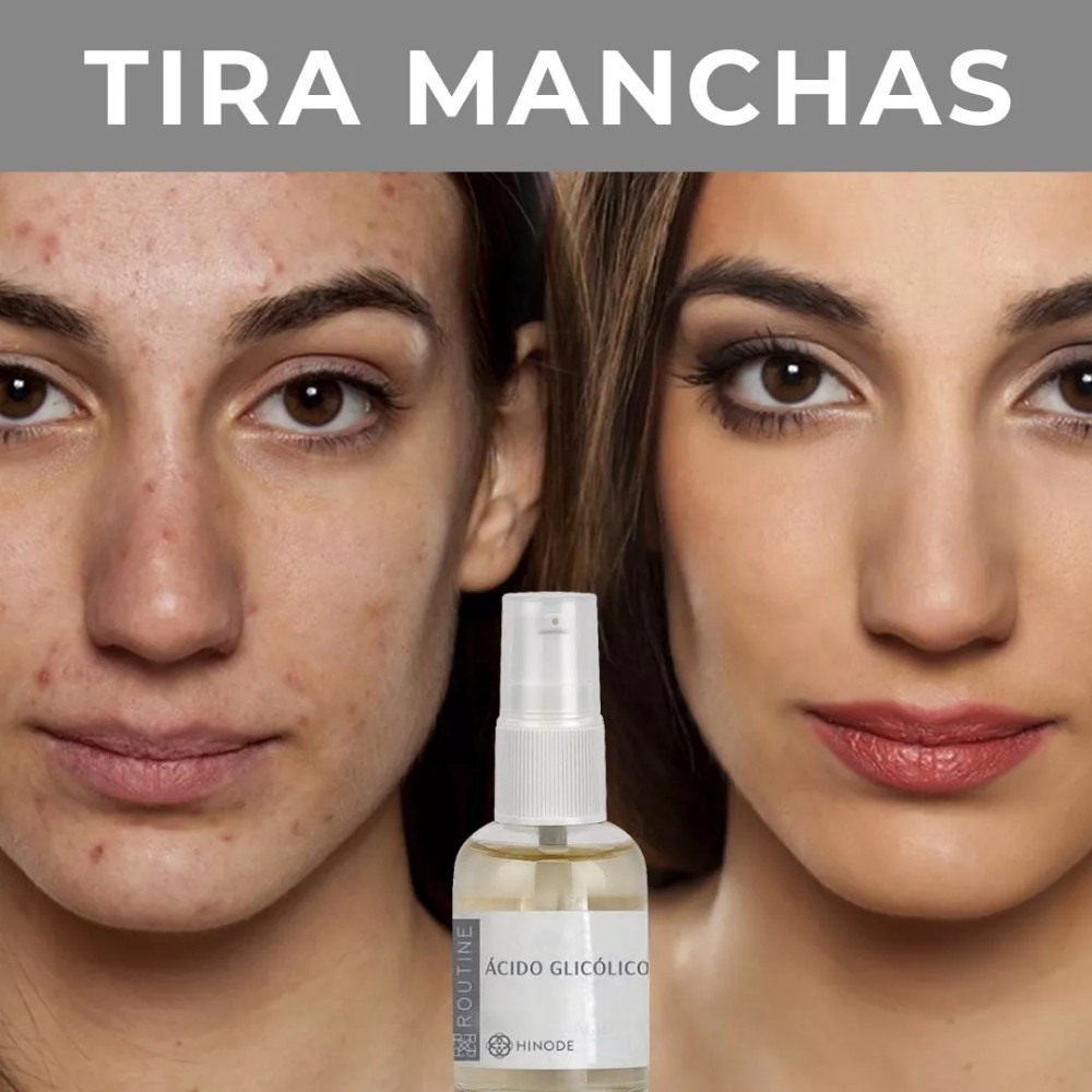 Acido Glicolico Hinode Tira Manchas Acne Rugas Original Da Hinode Shopee Brasil