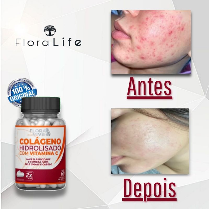 Remove espinhas, Tratamento para acne, estética facial: Colágeno Hidrolisado com vitamina C