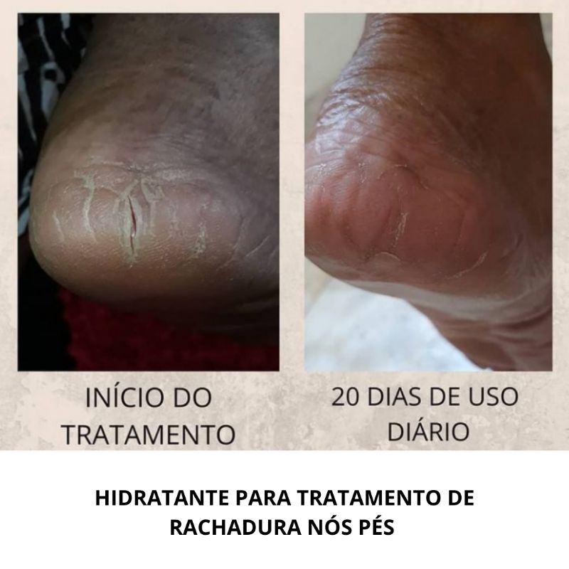 Tratamento de rachaduras nos pés. | Shopee Brasil