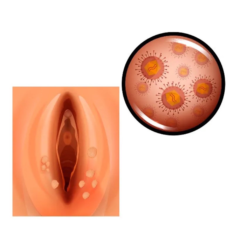 Hpv ou herpes genital, Hpv provoca herpes genital - Virus herpes simplex - Wikipedia