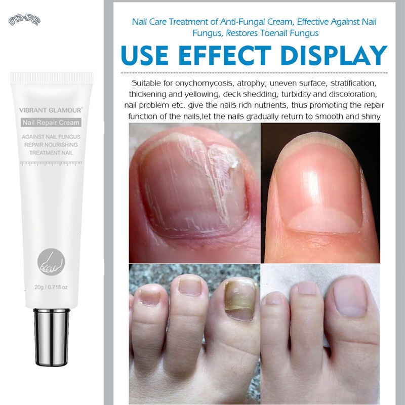 Elaimei Nail Fungal Onychomycosis Treatment Hand Foot Toe Nail Fungus  Remover Cream The Herb Nail Repair Cream Buy Onychomycosis Treatment Cream ,Nail  Repair Cream,Effective Nail Repair Cream Product On | Eelhoe Nail
