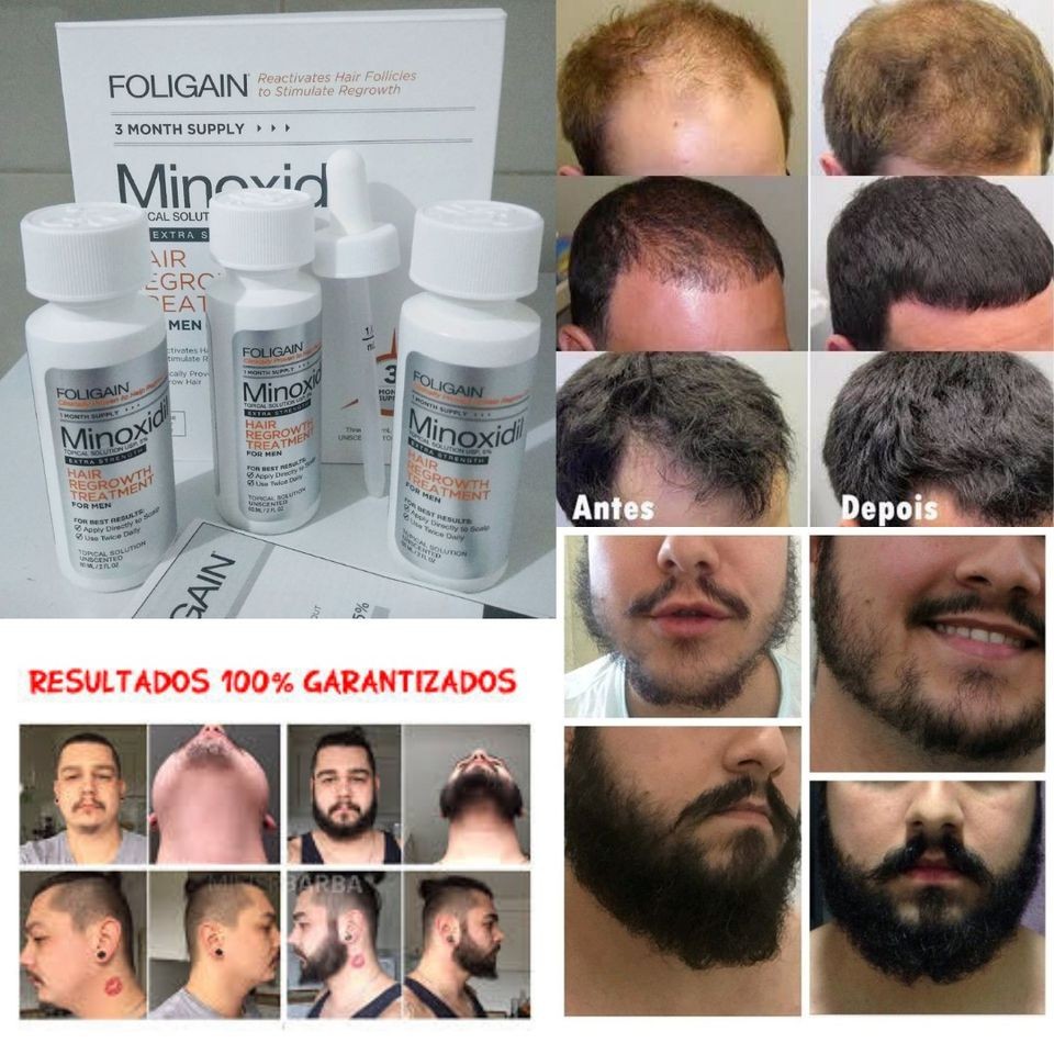 MINOXIDIL FOLIGAIN, SOLUÇÃO 5%