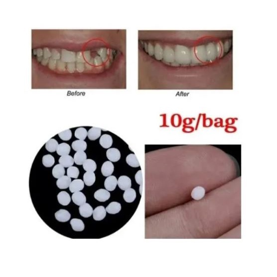 Massa Restauração Dente, Tampa Buraco Dental. Provisórios
