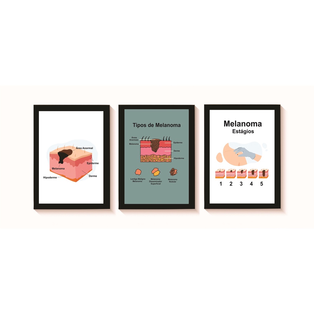 Kit 3 Quadros Decorativos Melanoma Consultório Dermatologia Oncologia Molduras 20x30cm Madeira Vidro