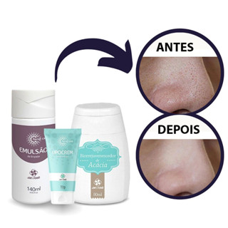 Removedor de Cravos Espinhas Acne Limpeza Pele Profunda Kit Completo Jan Rosê