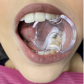 Abridor de boca Lysanda - isolamento relativo em Oferta na Shopee