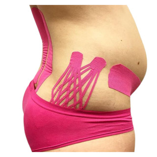 Bandagem Taping Para Pós Operatório De Cirurgia Plástica Cesárea Pós Parto