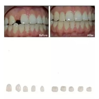 coroas ocas para os dentes 06 Peças Cor A2 + massa ( bolinhas ) Pronta Entrega