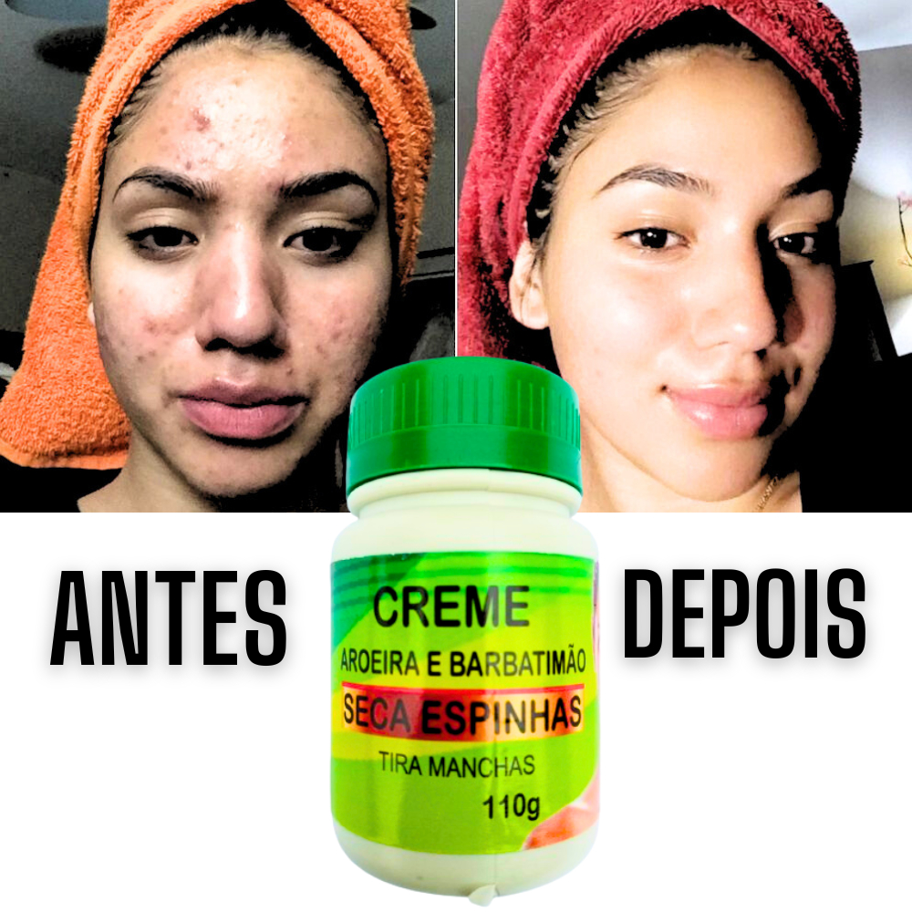 Creme Facial Seca Espinhas e Tira manchas do Rosto Melasma Aroeira e Barbatimão