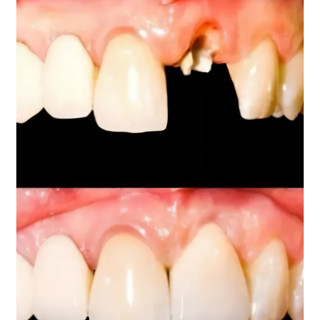 20 Dentes Postiços, Incisivos Centrais Ocos A3+massa Fixar. Dentes da frente. Dentes Postiços, Removível, Ocos, de Encaixe, Reposição Dentária