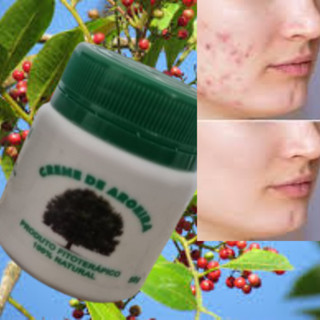 Creme Facial Seca Espinhas e Tira manchas do Rosto Melasma Aroeira