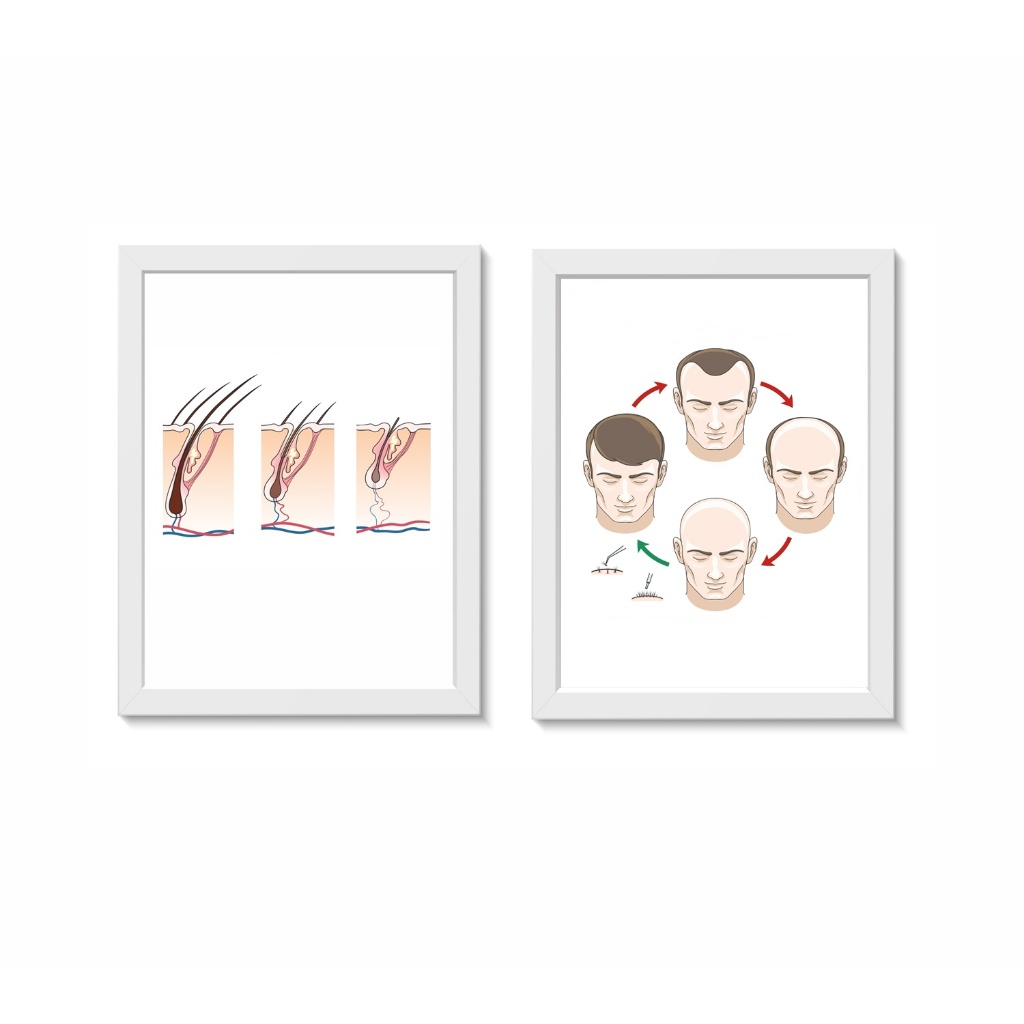 Kit 2 Quadros Decorativos Implante Capilar Dermatologia Tricologia Medicina Moldura 20x30cm Madeira