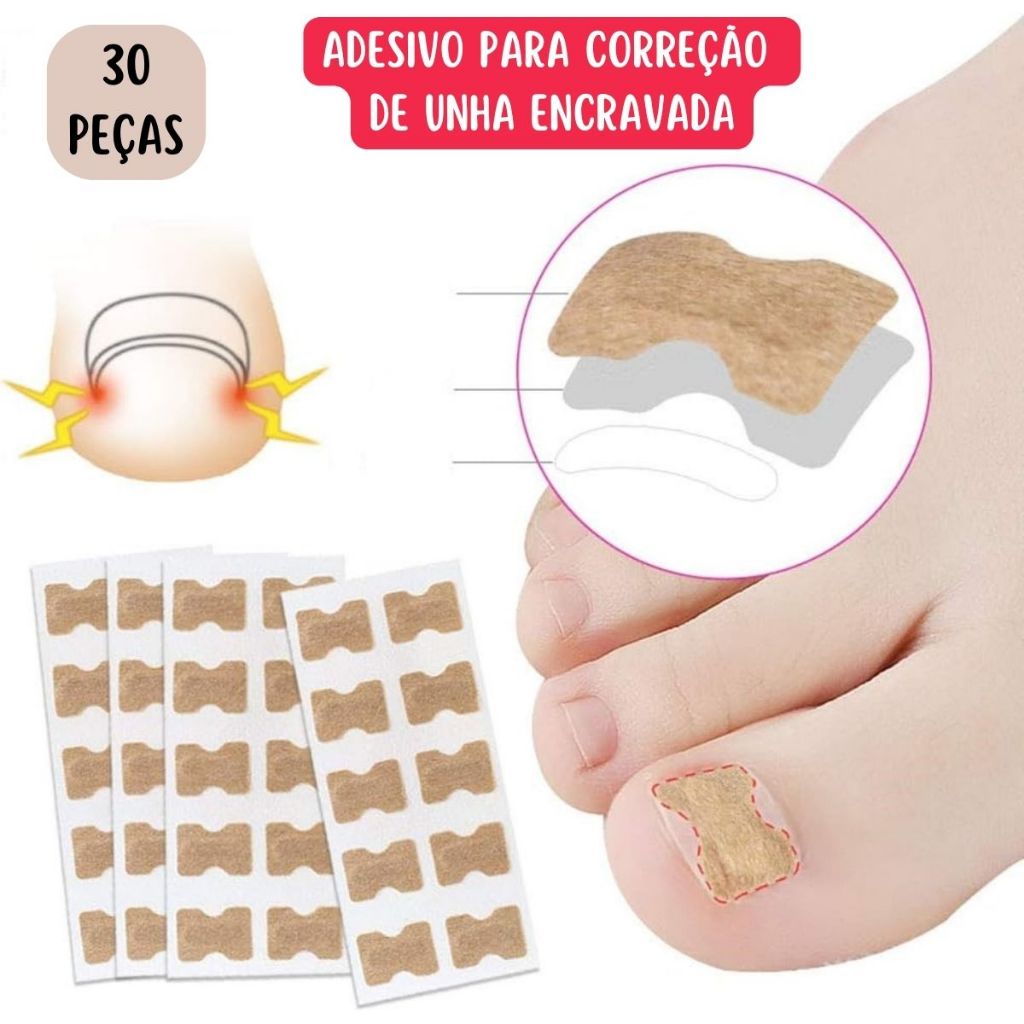 Kit 30 Adesivos Órtose Correção de Unhas Encravadas Manicure Pedicure