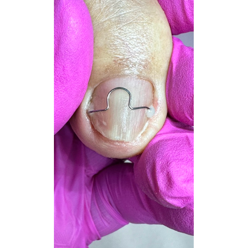 podologia órtese de fio ortodôntico em ômega para unhas encravada