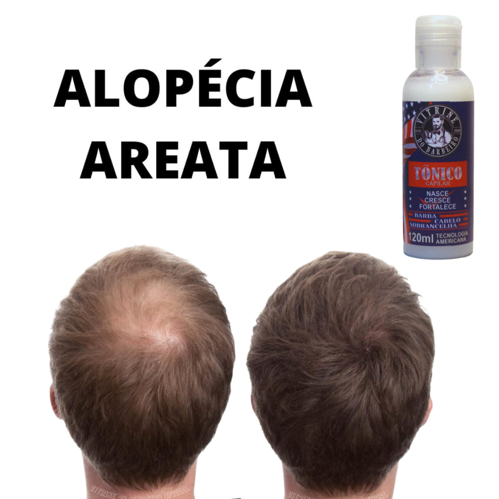 Estimular o Crescimento do Cabelo: Onde Comprar | BuscaProdutos