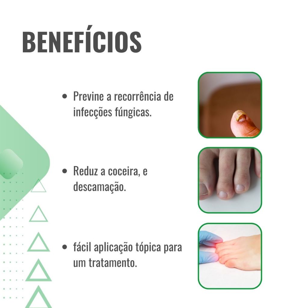 Solução Anti Micose Plus 30ml Tratamento de Micose e Fungos em Unhas