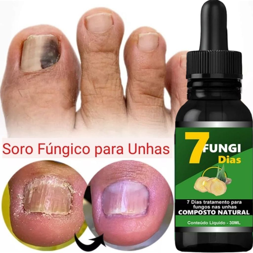 1 TRATAMENTO DE MICOSE PARA UNHAS em Oferta na Shopee