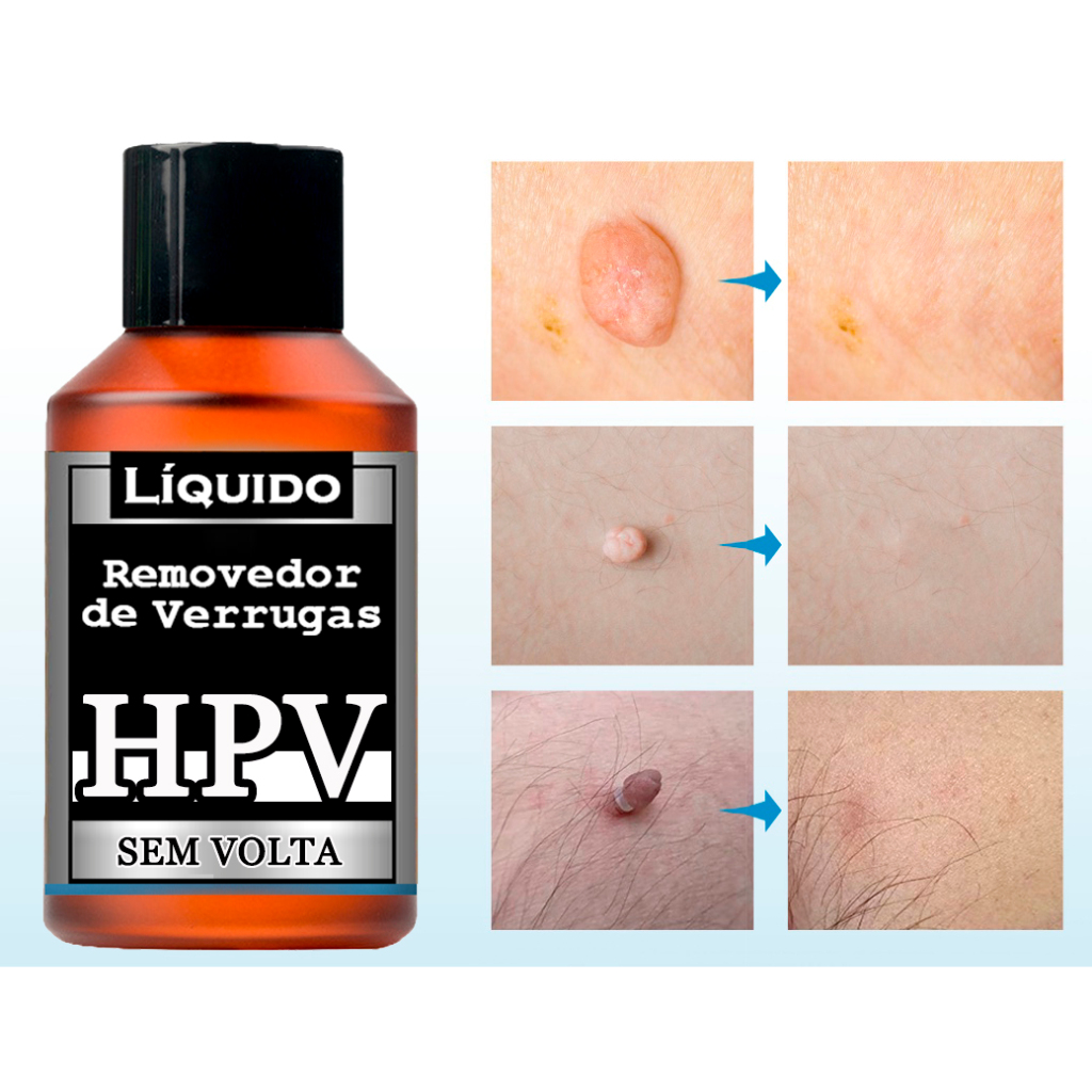 Tira e Remove - Removedor 5ml - envio rápido