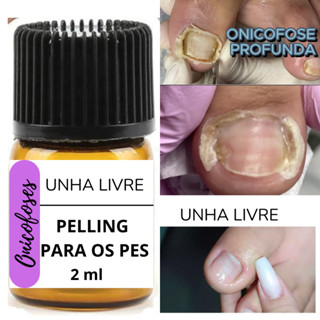 PELLING PARA OS PES, REMOVE ONICOFOSES E CALOSIDADES 2ML em Oferta na Shopee