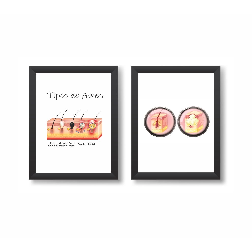 Kit 2 Quadros Decorativos Tipos de Acnes Dermatologia Molduras 20x30cm Madeira Vidro Cor Pretas