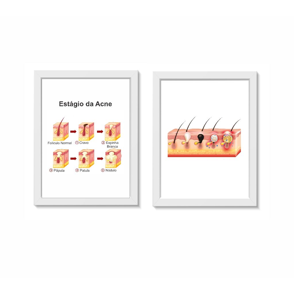 Kit 2 Quadros Decorativos Acnes Dermatologia Medicina Molduras 30x40cm Madeira Vidro Cor Brancas