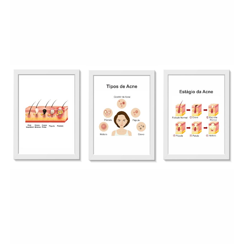 Kit 3 Quadros Decorativos Acnes Dermatologia Medicina Molduras 30x40cm Madeira Vidro Cor Branca
