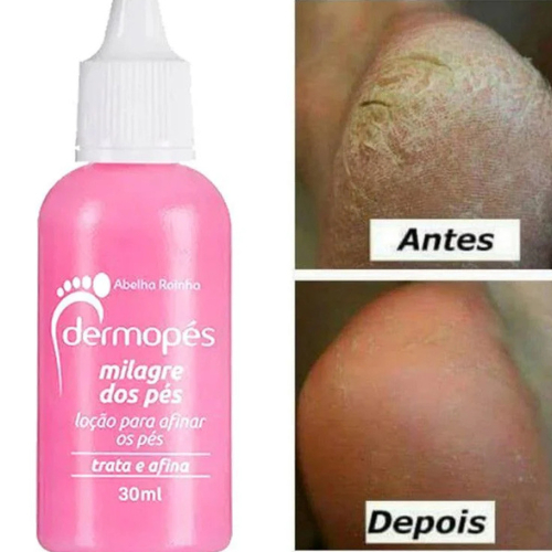 Gota mágica Dermopés Trata e Afina Pés Abelha Rainha 30ml Loção Milagre dos pés