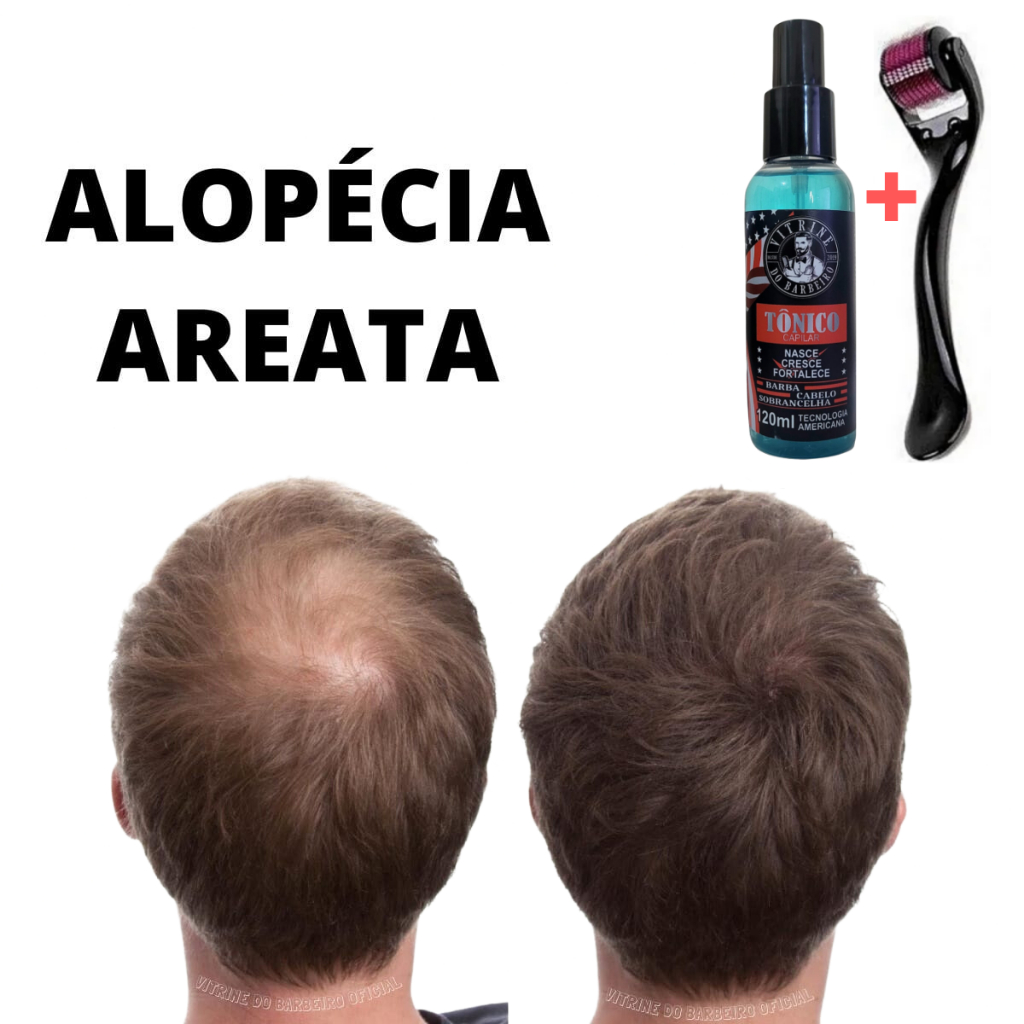 Dermaroller + Tônico Capilar O Melhor Kit Para Estimular o Crescimento Do Cabelo