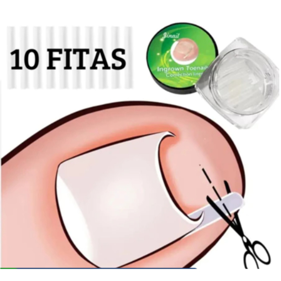 10 Fitas Órtese Para Unha Encravada Dedo Do Pé Unha