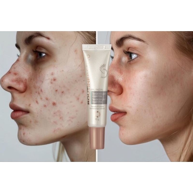 Gel Facial Secativo Routine Dermo Para Acne - Original