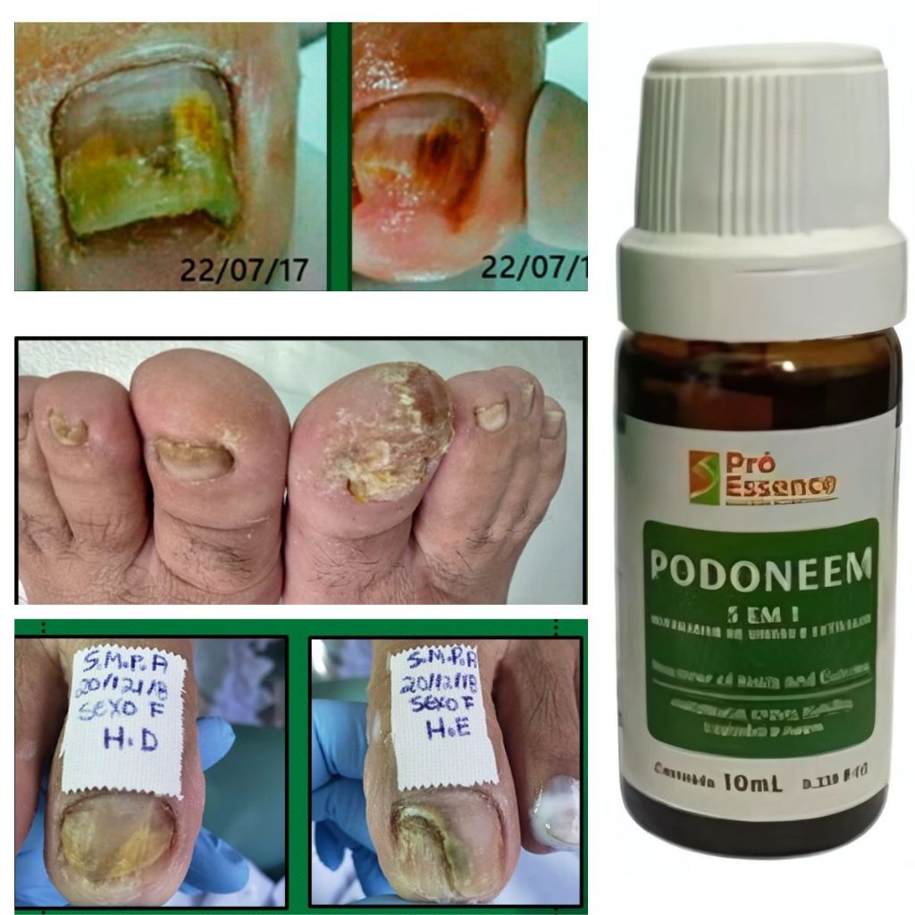 Podoneem 5 Em 1 Tratamento Para Unhas Com Fungos E Micose